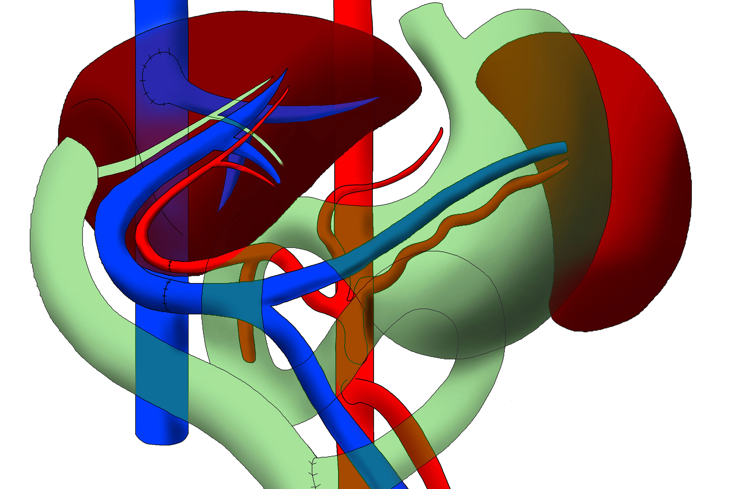 Left_Liver_Transplant-1