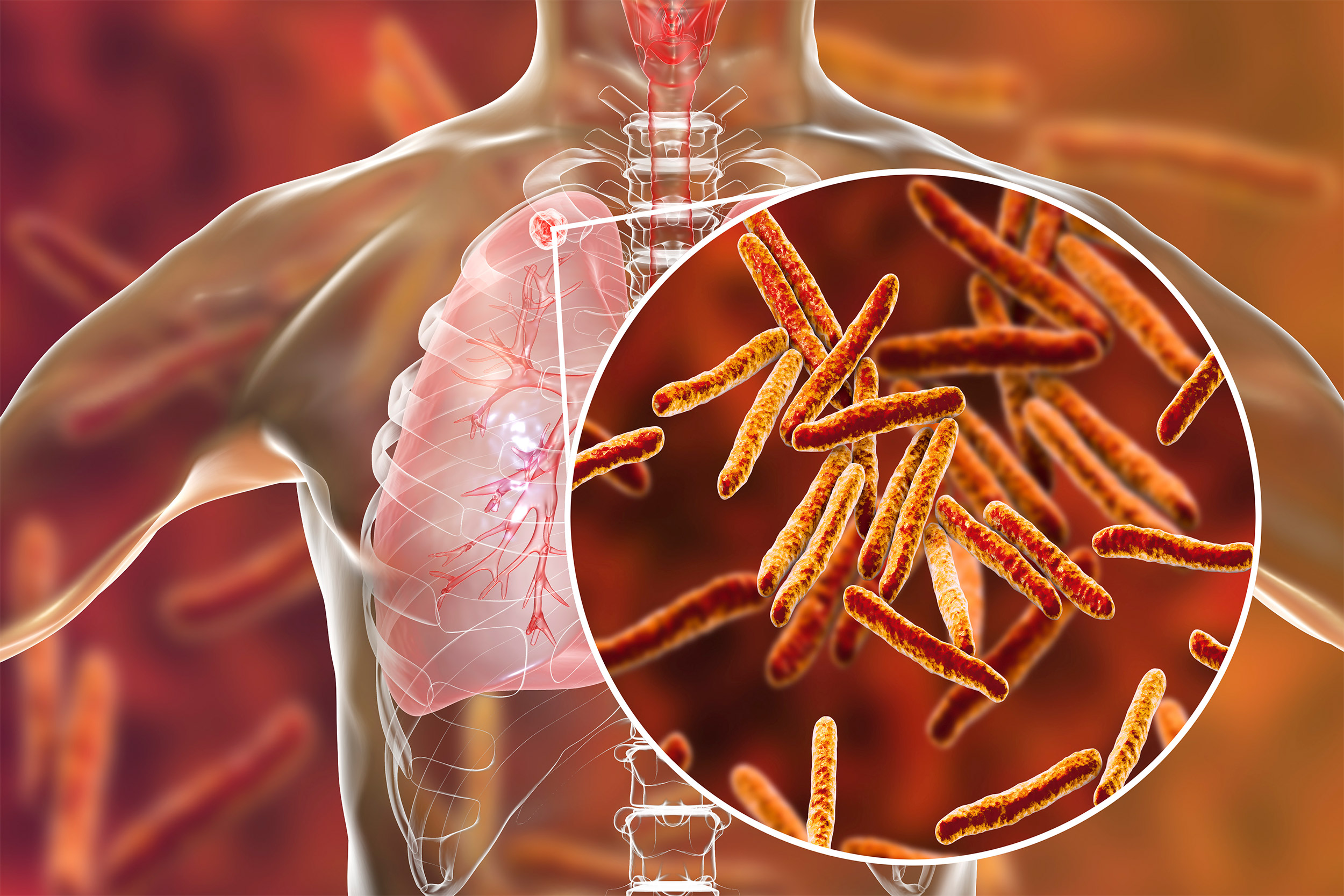 Secondary tuberculosis in lungs and close-up view of Mycobacterium tuberculosis bacteria, 3D illustration