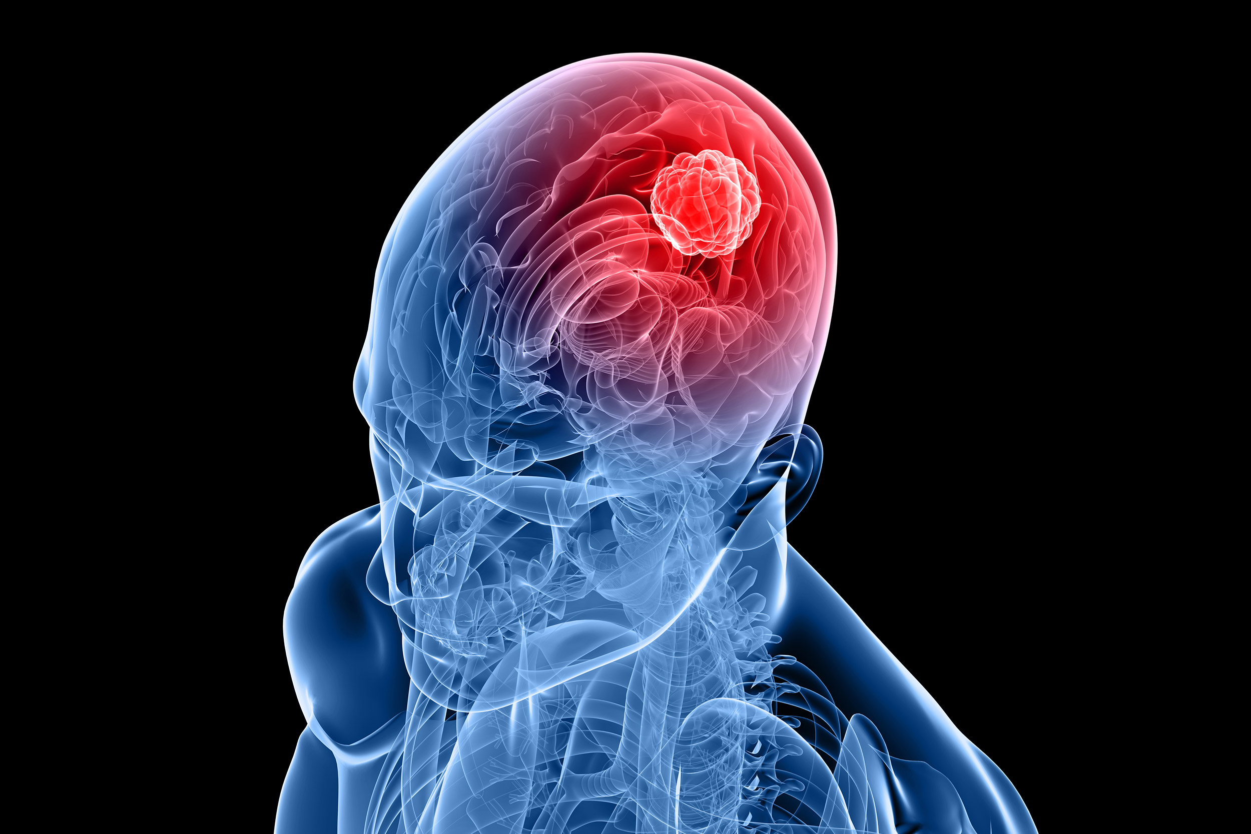 A 3-D image of a human skull and brain depicting cancer.