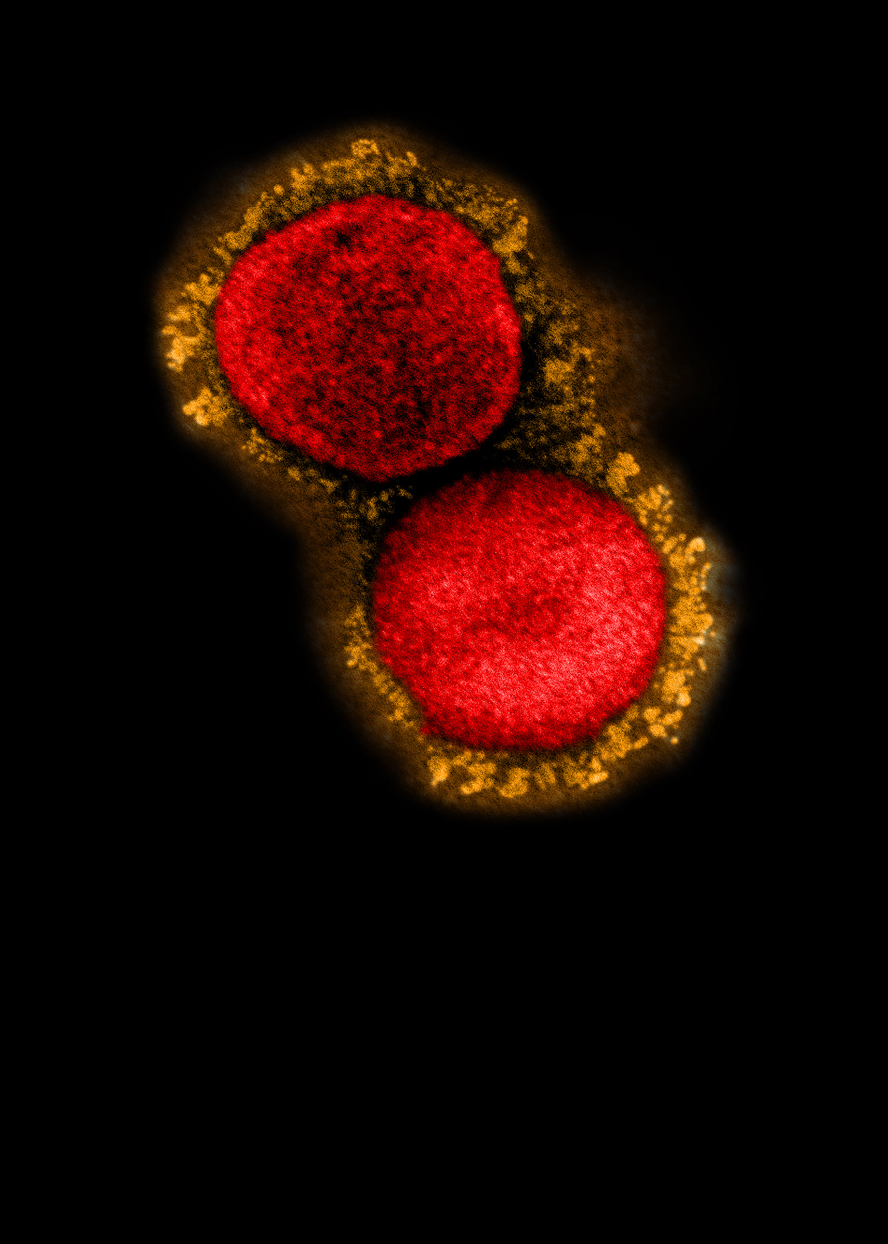 SARS-CoV-2 virus particles (U.K. variant)