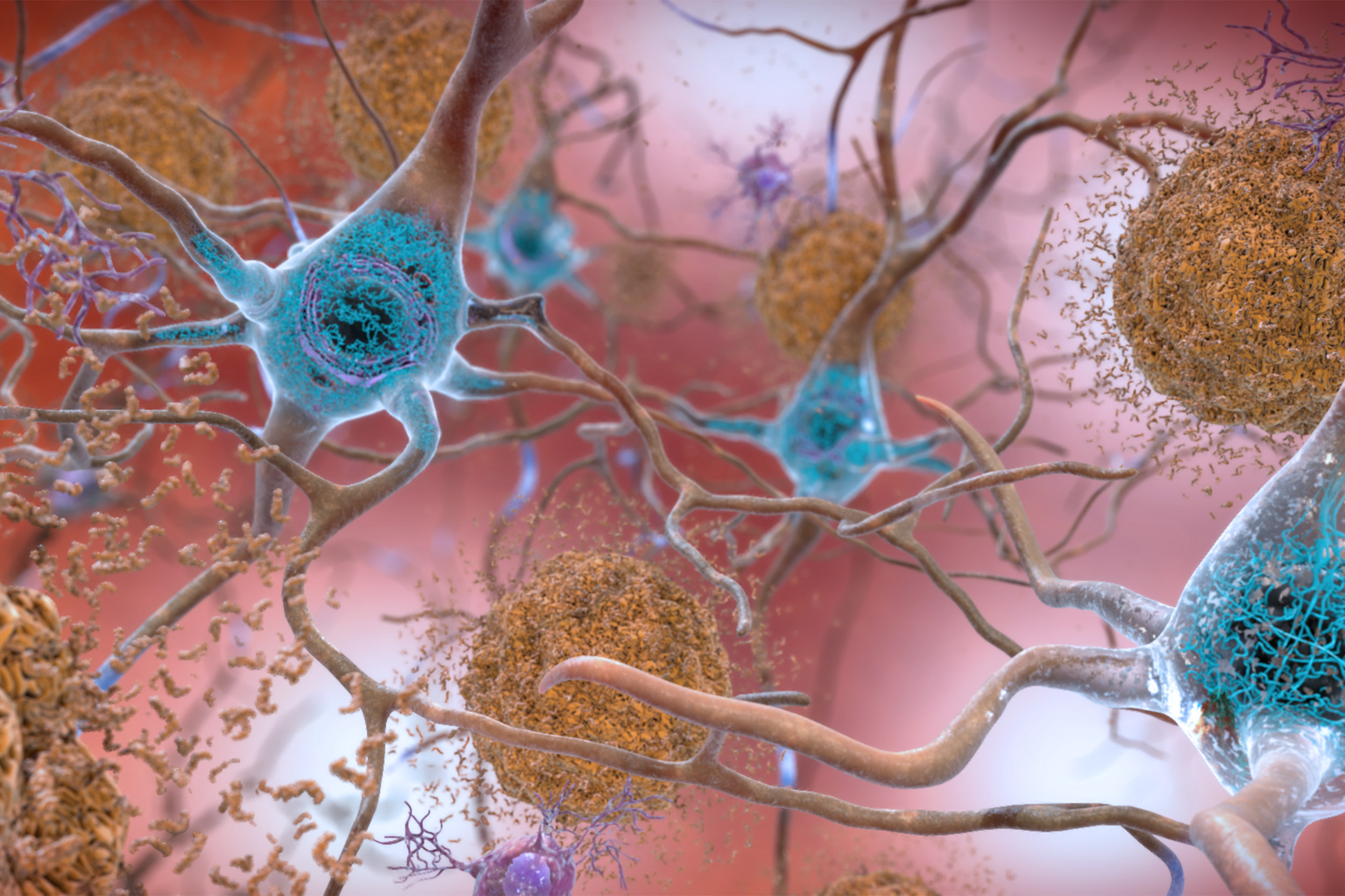 Beta-amyloid plaques and tau in the brain.