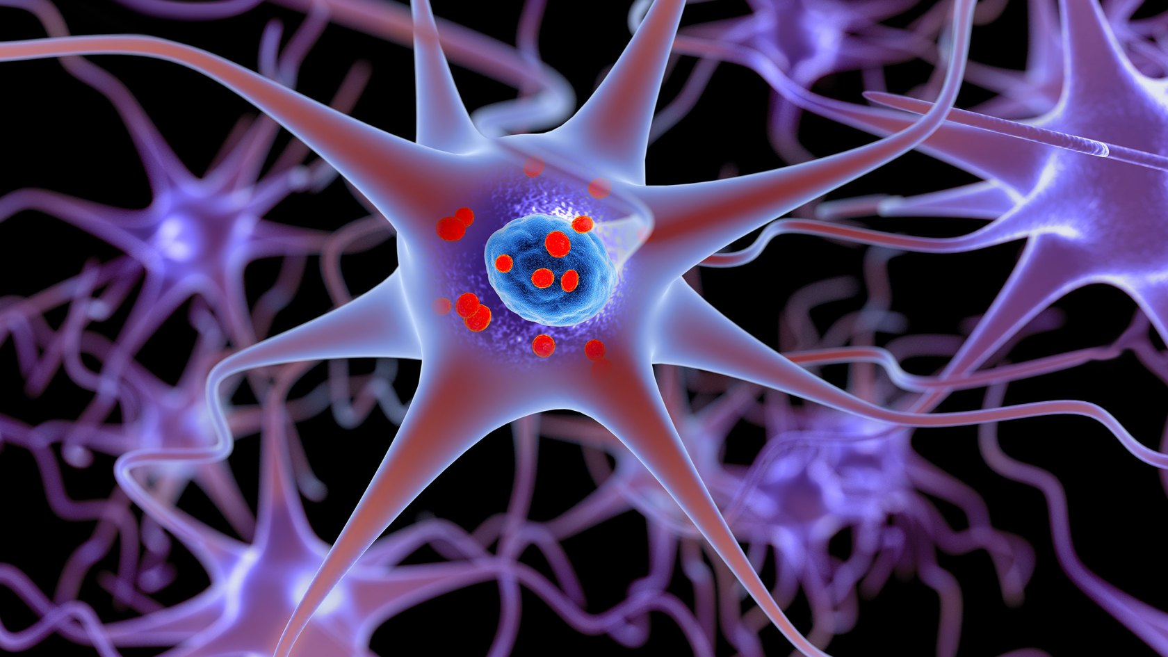 Illustration shows neurons containing deposits of alpha-synuclein (indicated with small red spheres) that have accumulated in the brain cells.