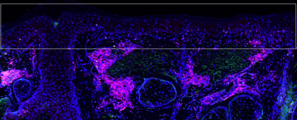 Precancerous actinic keratosis cells –