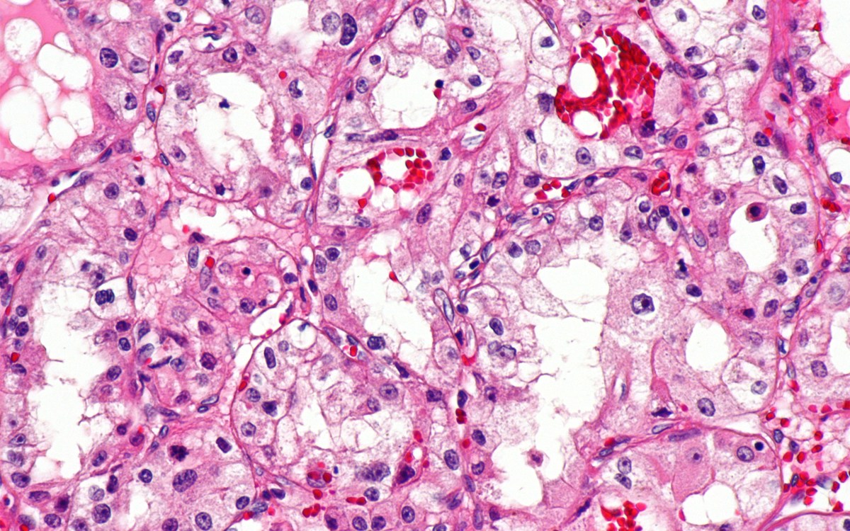 Micrograph of clear cell renal cell carcinoma.