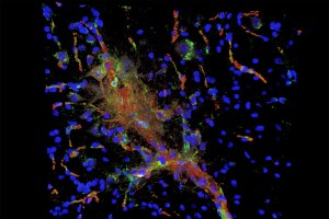 Microscopic image showing inflammation.