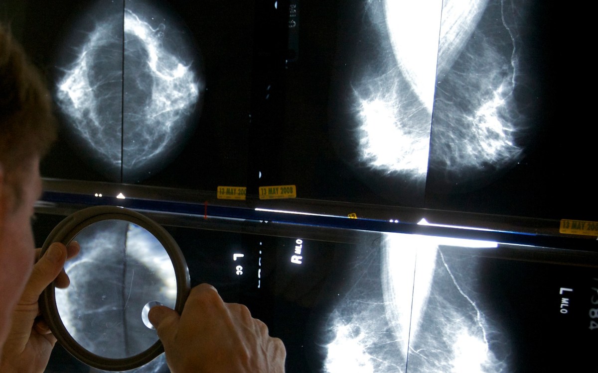 Radiologist examines mammograms with magnifying glass.