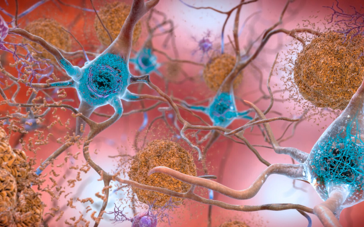 Illustration of cells in an Alzheimer’s affected brain.