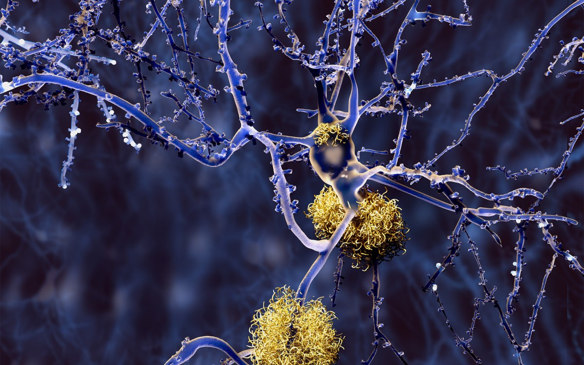 This illustration shows neurons with amyloid plaques, a hallmark of Alzheimer’s disease, in yellow.