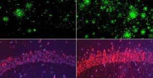 One pair of boxes shows fewer green amyloid clusters on the left and more on the right. Another pair of boxes shows a dim arc of purple and red tau on the left and a brighter arc on the right.