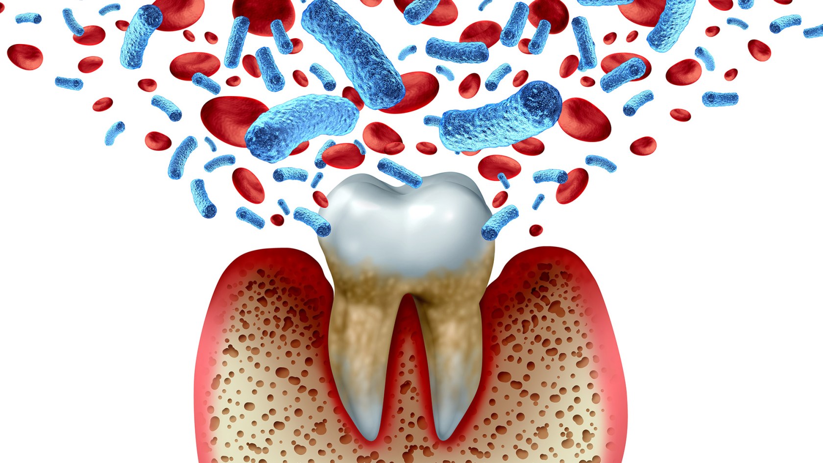 Illustration of tooth decay with inflammation and gum disease.