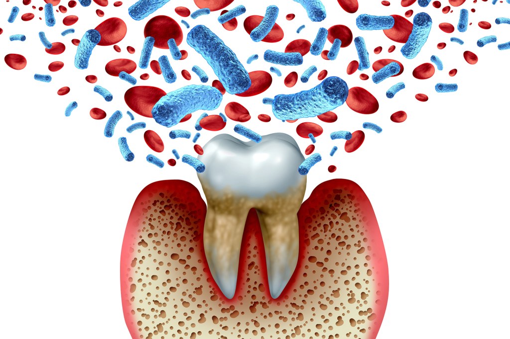 Illustration of tooth decay with inflammation and gum disease.